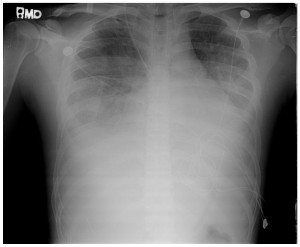 This chest x-ray shows almost complete "white out" of both lungs due to the collection of inflammatory fluid in the alveoli. The fluid further restricts oxygen uptake, promotes more sickling and leads to a vicious cycle of deterioration.