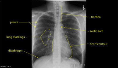 This is normal chest x-ray. The pleura are the membranes which cover the surface of the lungs and help them to move freely within the chest. The trachea or windpipe delivers air to the lungs. The lungs themselves, if they are full of air are black, the markings on them are the blood vessels and small airways, along which blood and air travel to the alveoli. The heart is the white shadow in the centre of the chest.