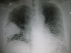 The circled, white area is infection or pneumonia in the right lung.